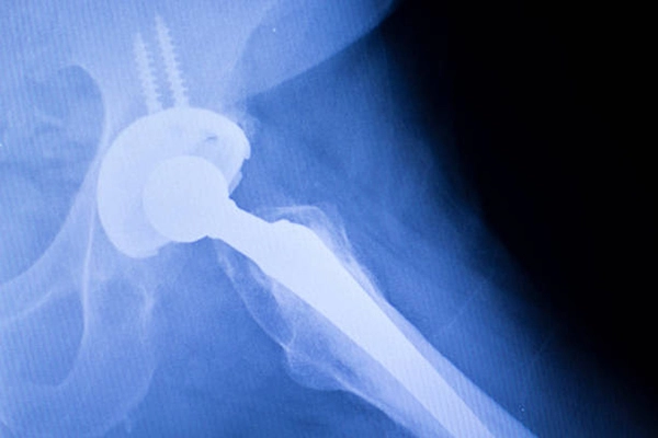 Medical titanium plates