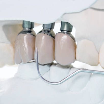 Surgical Grade Titanium Bar